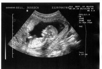 What will the ultrasound show (8 weeks pregnant)?